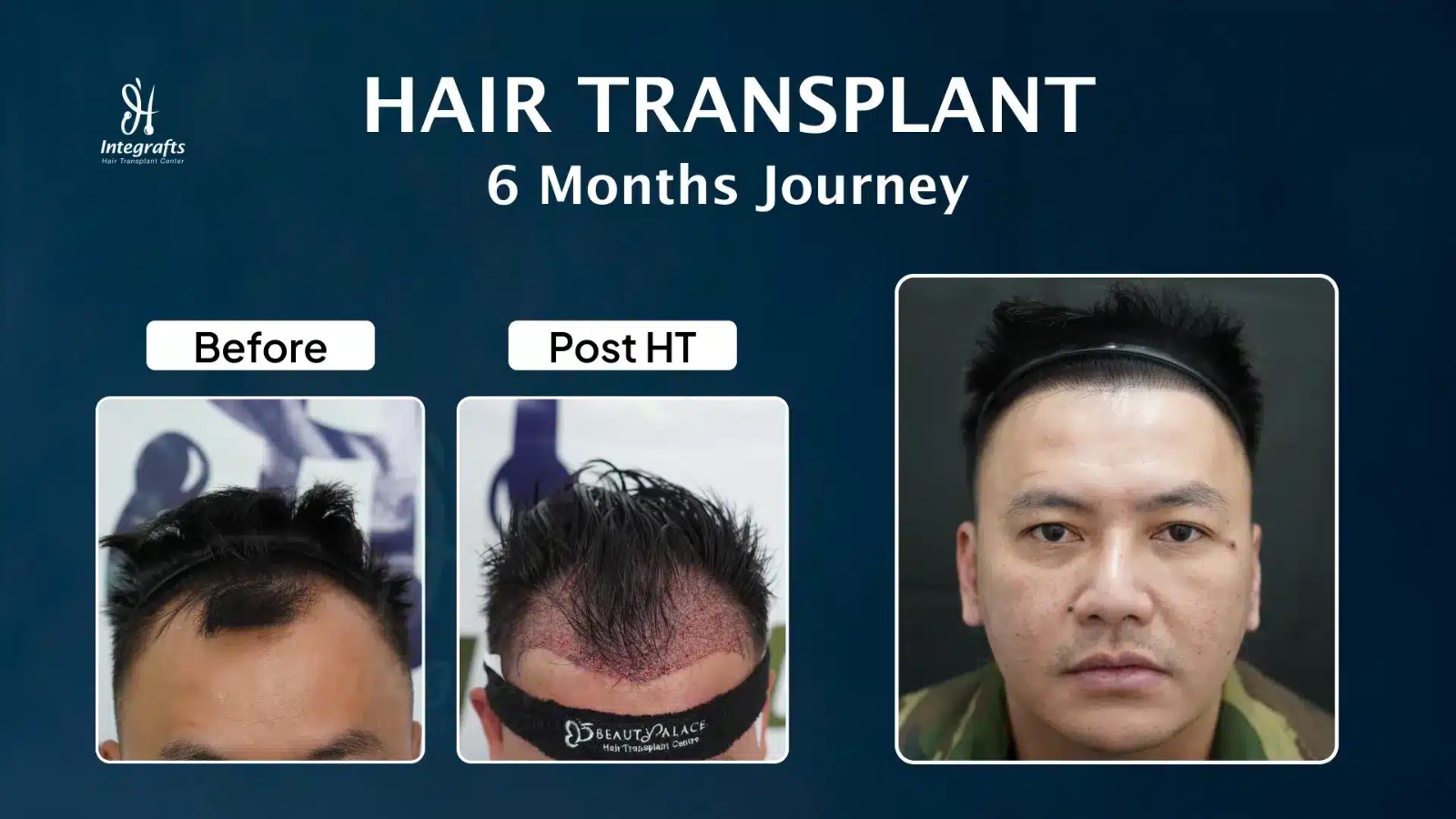Nggak Perlu Minder Lagi, Ini Alasan Transplantasi Rambut Semakin Diminati